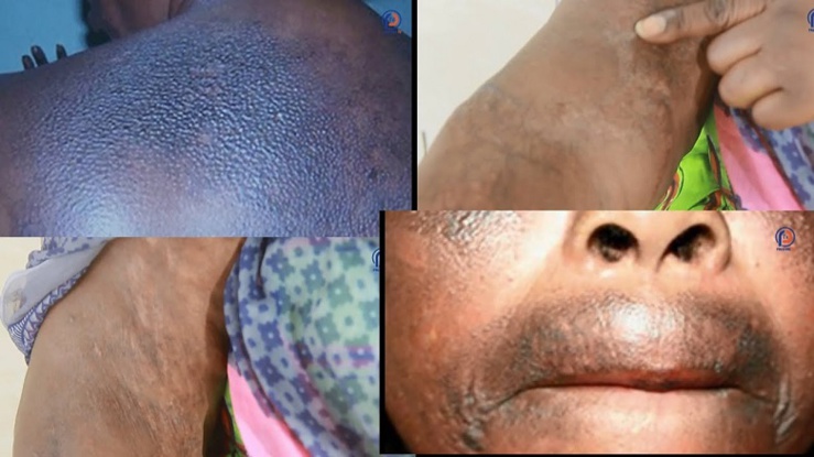 Xessal ou dépigmentation de la peau au Sénégal. Xessal ou dépigmentation de la peau au Sénégal.