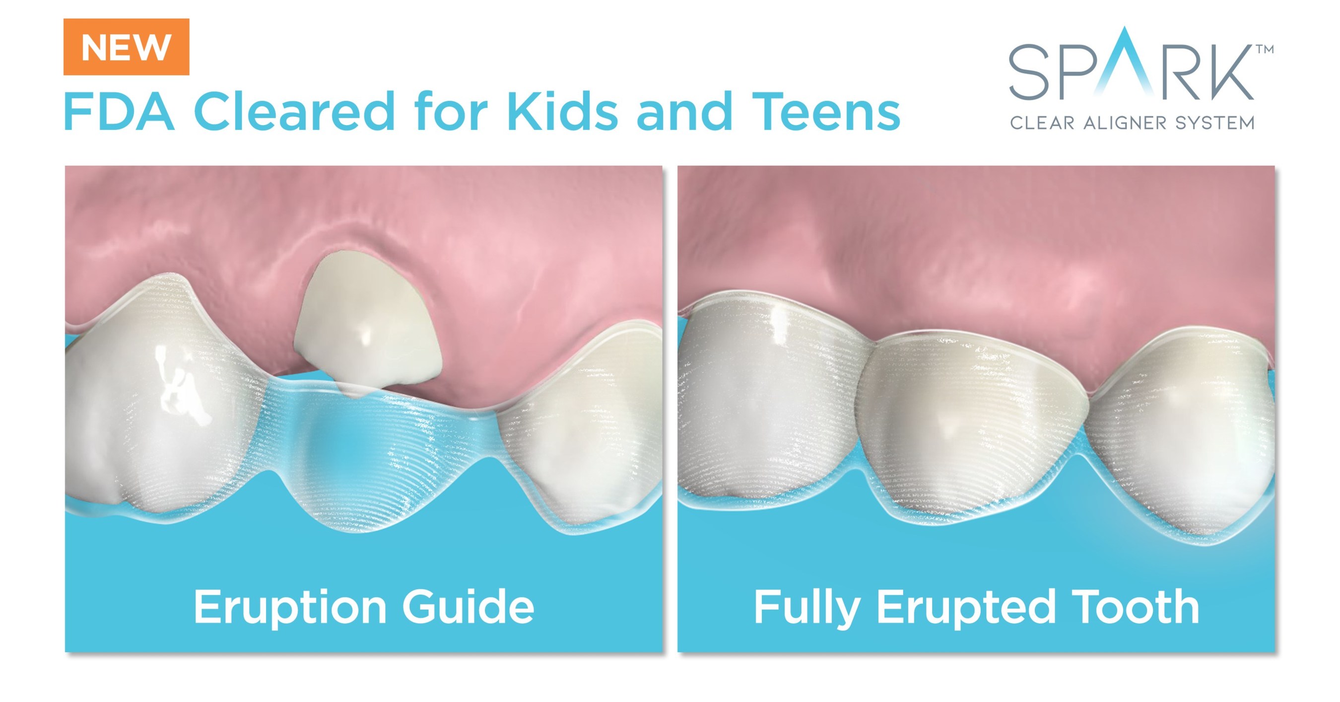 La nouvelle version 12 des aligneurs transparents Spark La nouvelle version 12 des aligneurs transparents Spark